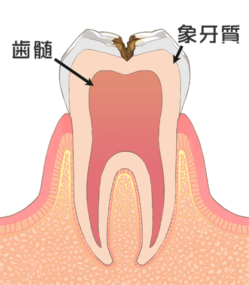 C2（象牙質の虫歯）