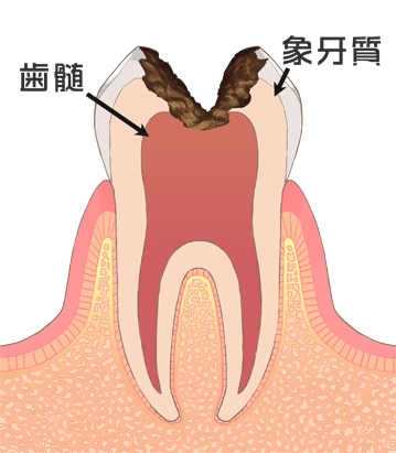 C3（歯髄の虫歯）