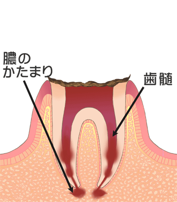 Ｃ4（末期の虫歯）