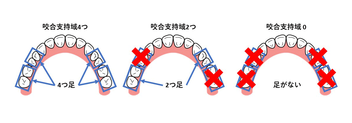 インプラントとは